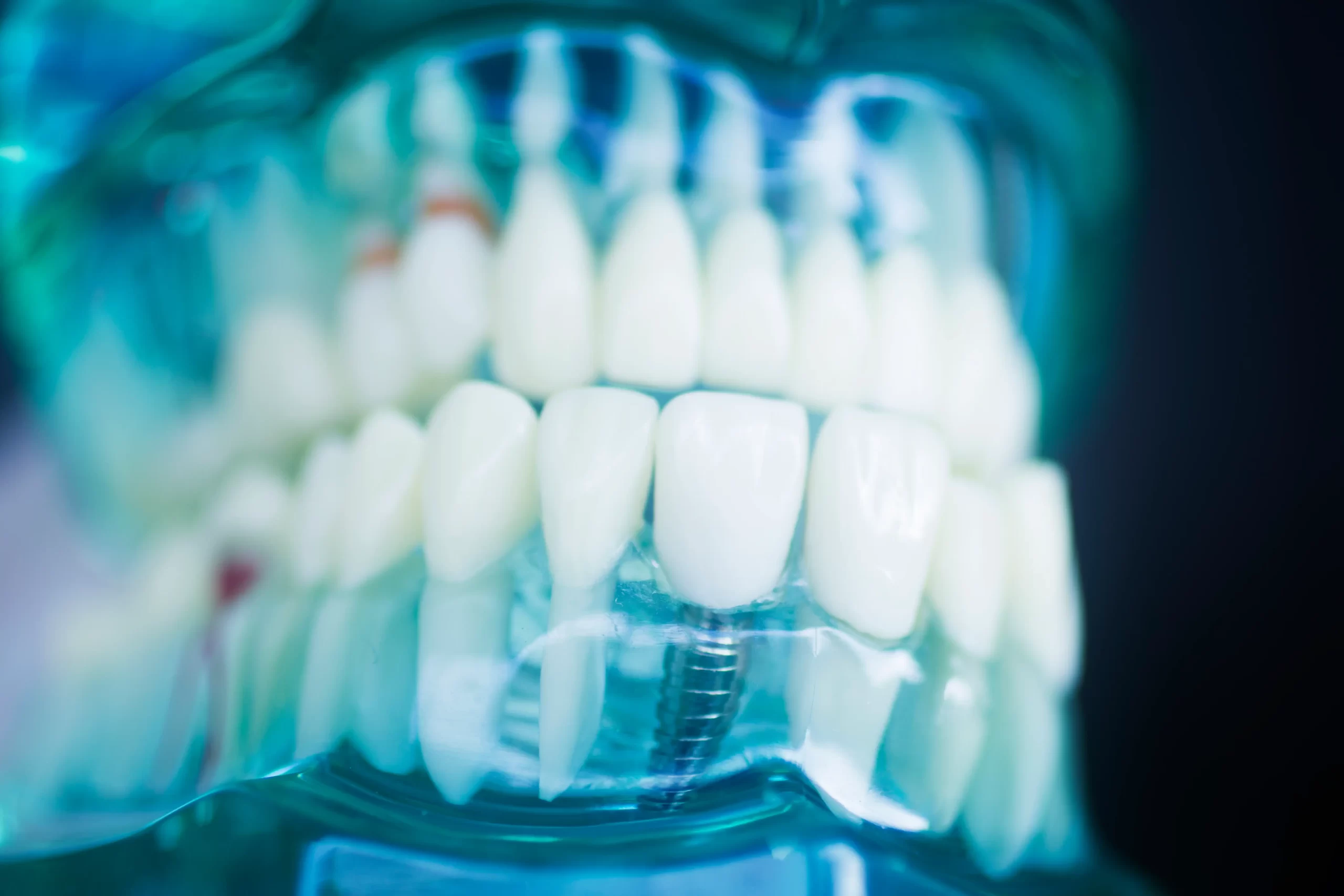 Errores comunes en implantes dentales y cómo evitarlos: guía para odontólogos